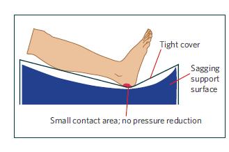 Surface Support surfaces alone neither prevent nor heal pressure ulcers.