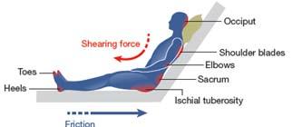 Shear Shear stresses are thought to act alongside pressure to produce the damage and ischemia (death) of the skin and deeper tissues that results in pressure ulcers.