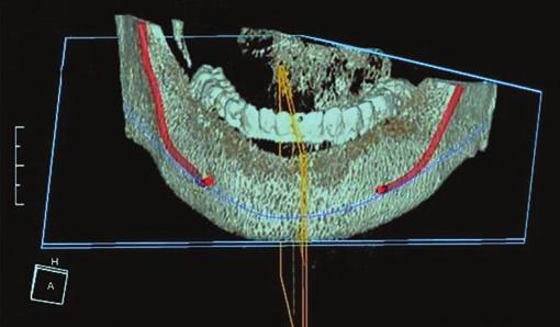 9 Implant region Anterior maxilla 129 24.4 Posterior maxilla 133 25.2 Anterior mandible 122 23.1 Posterior mandible 143 27.