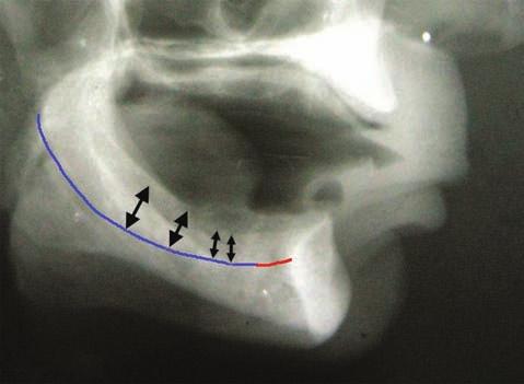Only one implant was reported in each edentulous space in about 44.4% patients.