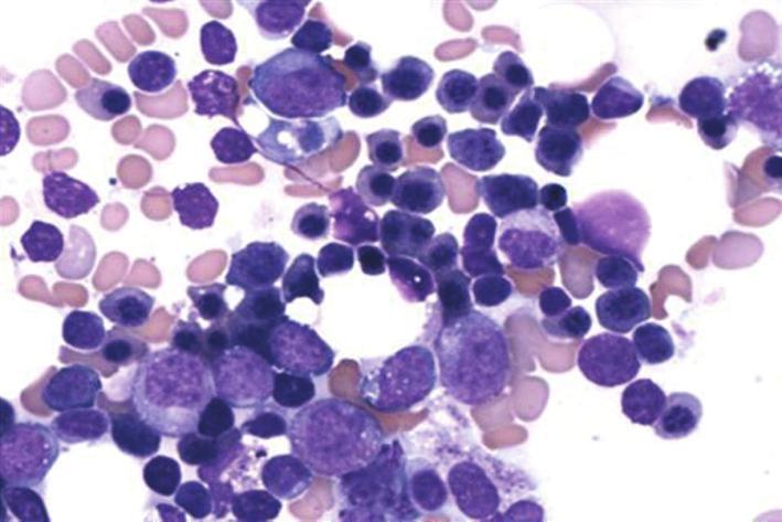 2 Case Reports in Oncological Medicine 10 5 (a) HLA-DR APC-A 10 4 10 3 10 2 10 2 10 3 10 4 10 5 CD34 PE-Cy7-A (a) (b) Figure 1: (a) Bone marrow aspirate on diagnosis showing myeloid hyperplasia with
