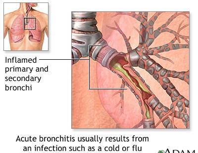 The bronchi In the presence of infection, the bronchi