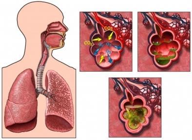 The lungs Pathogens, white cells and immune proteins present during an infection may cause the air sacs to become inflamed and filled with fluid.