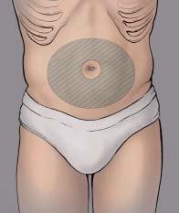 3. To locate injection sites on the abdomen, place your hands on the lower ribs and draw an imaginary line below them.