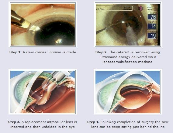 Painless Cataract Surgery Thanks to recent developments in anaesthesia, cataract surgery is a painless experience and the vast majority of operations are now done as a day case procedure.