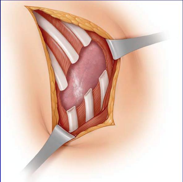 Large resections of the chest wall, including the ribs, sternum, and/or surrounding soft tissue, are performed for the curative and palliative treatment of malignant and benign tumors, radiation
