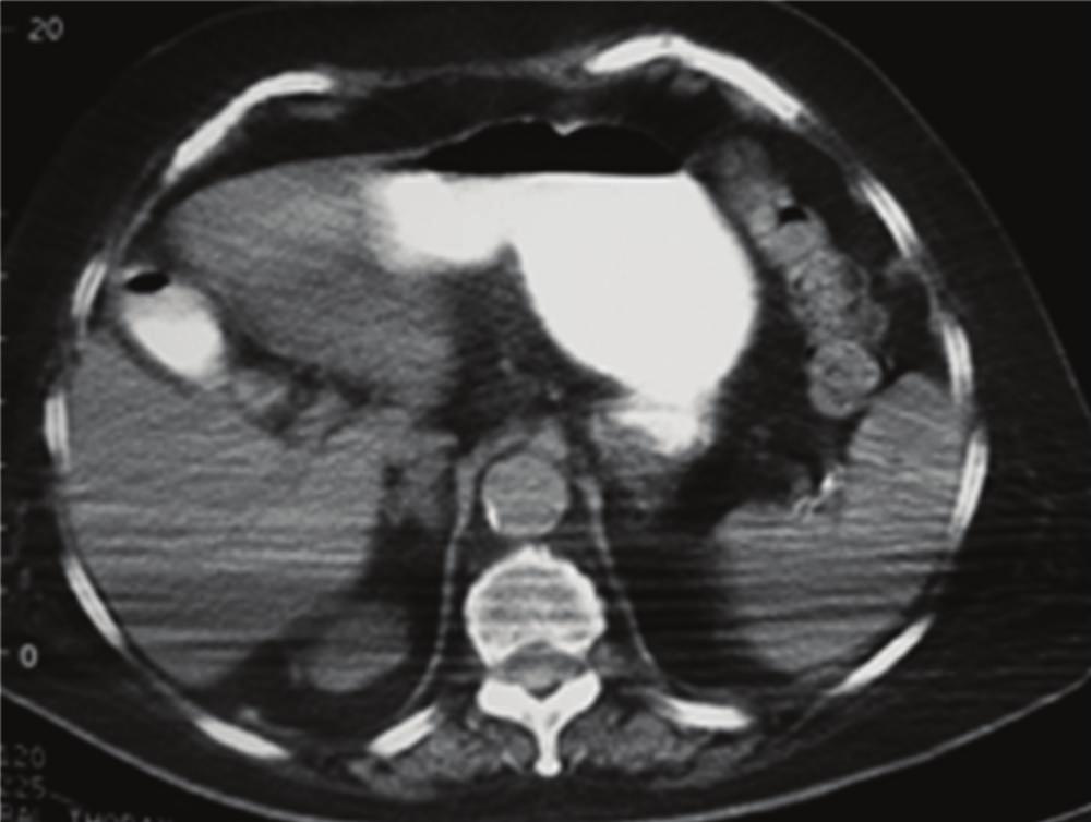 The abdominal X-ray was suspicious for presence of air in the gallbladder (Figure 1).