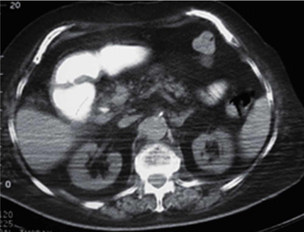 The stomach was found dilated and filled with liquid. Abdominal CT showed the presence of a gallstone in the 2nd to 3rd part of the duodenum and a dilatation of the first part.