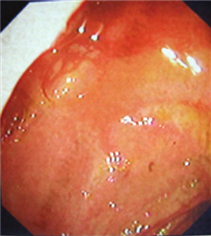 The formation of a fistula is favoured by the long history of cholelithiasis, the repeated episodes of acute cholecystitis, the large size of the calculi (2 8 cm), the female gender and the advanced
