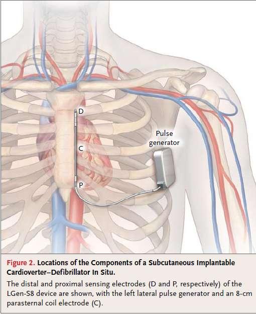 An Entirely Subcutaneous Implantable Cardioverter Defibrillator Four Configurations of a Subcutaneous