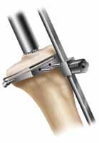 The stylus can be adjusted for a 1-13mm tibial resection by twisting the knob on top of the stylus.