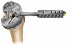 Quick-connect Handle 3 Place a trial insert into the stemless tibial trial tray and perform a trial range of motion to allow the baseplate to center on the femoral trial.