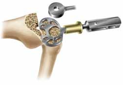Option B stemmed tibial trials 1 Place a tibial drill guide one size below the femoral component size on the cut tibia to assess coverage. As needed, additional sizes should be templated (Figure 22).