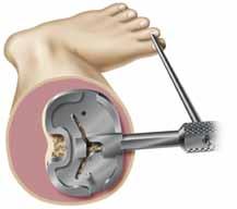The quickconnect handle may be attached to the tibial trial and used to set the appropriate rotational alignment. Option: Extend the knee fully with the handle attached to the tibial trial.