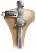 EM tibial preparation When using the extramedullary tibial alignment, the surgeon may use a non-spiked or spiked fixation rod.