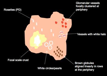 globules, shiny white streaks & pink hue Spoke wheel like Peripheral network & central hyperpigmentation IDN: comma/curved vessels, brown halo, brown pigmentation, globules