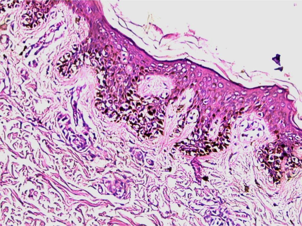 Microscopic Junctional component shows large cell