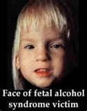Based on estimated rates of FASD per live births, FASD affects nearly 40,000 newborns each year.