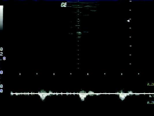and received Doppler signal converted into