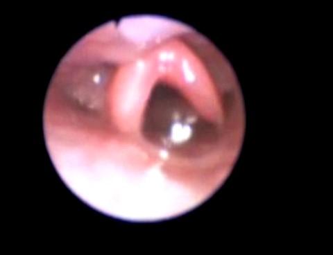 Classification of Laryngomalacia Functional Endoscopic evaluation of swallowing Clinic Evaluation of Infants and