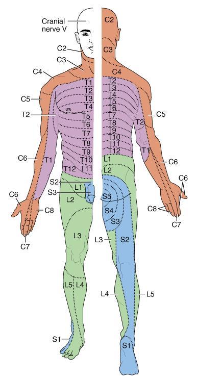Dermatomes Damaged regions of the spinal cord can be distinguished by patterns of numbness over a dermatome