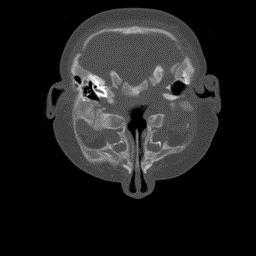 Differential diagnosis Neonatal rhinitis Masses Post nasal Teratoma space Anterior nasal space Glioma Midline