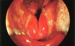 Acute Epiglottitis H.
