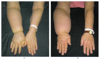 The problem with ALND: associated morbidities Lymphedema Limited