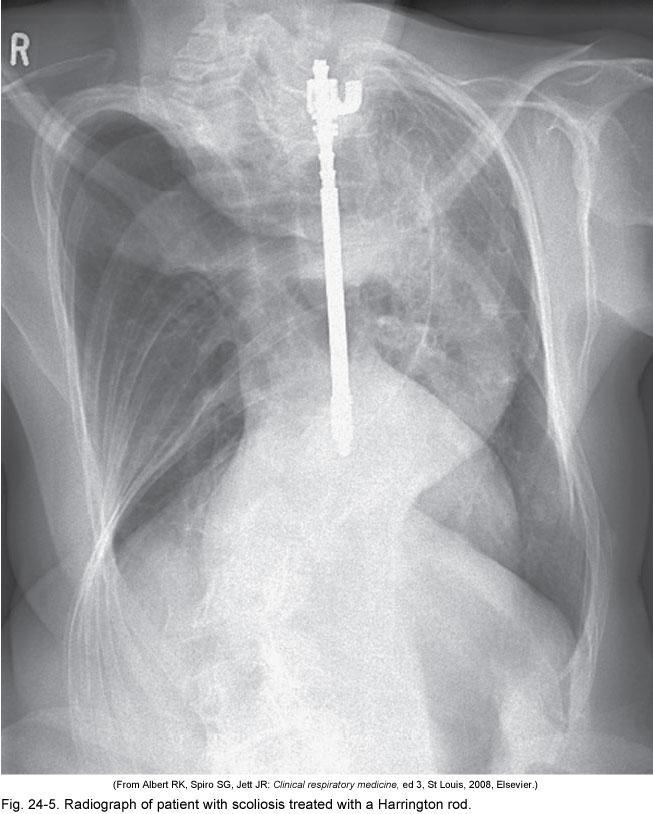 Figure 24-5 Radiograph of patient with