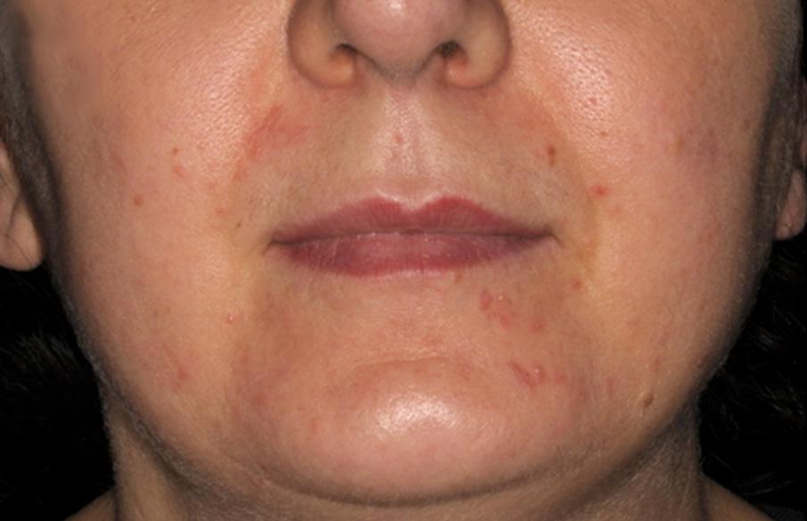 The TOLPOD Perioral Dermatitis Trial blished risk factor for POD 5. Treatment of POD can be a frustrating experience for patients and doctors.