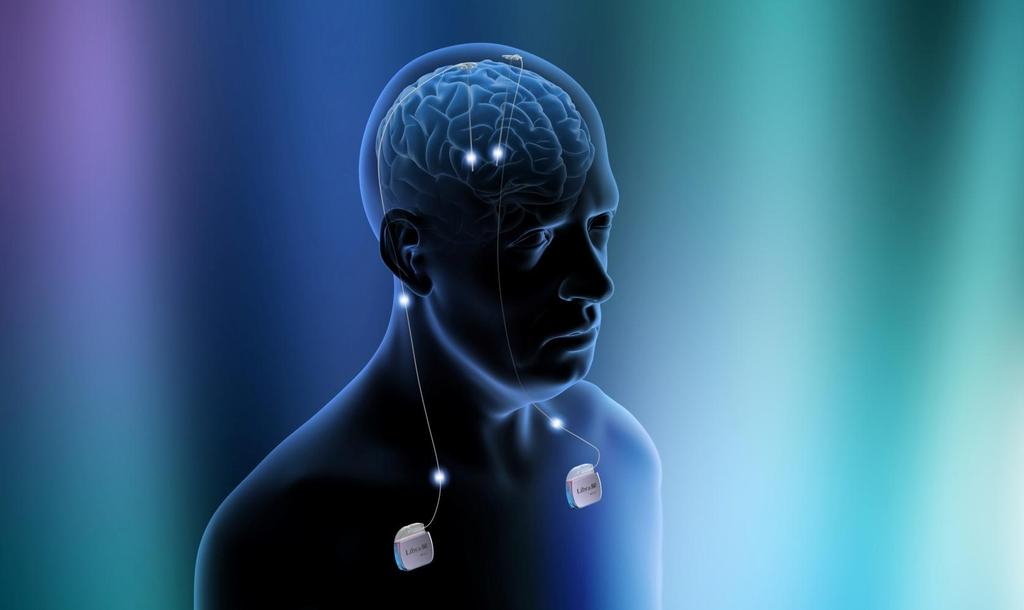 Deep Brain Stimulation (DBS) Stimulation electrode Subcutaneous extension wire Implanted