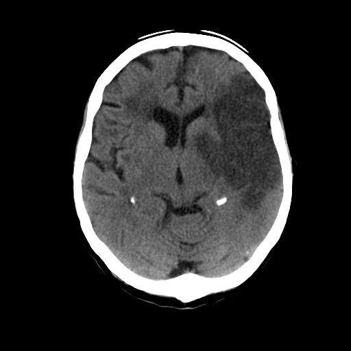 Framingham Patients with AF have a five fold increased risk of stroke 12,500 strokes