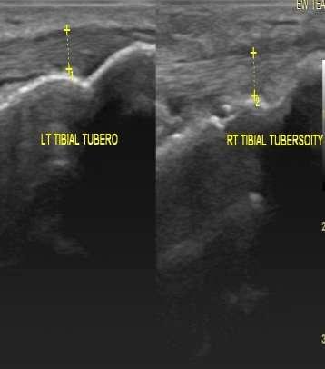 Tuberosity Erosion with Normal Left Tibial