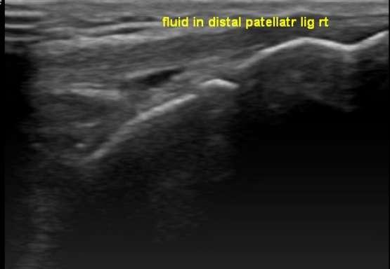 Ultrasound image Figure 5: Infra Patellar bursitis VI. Conclusion Psoriasis is one of the most common dermatological ailments seen in daily practice.