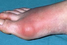 On examination This is the clinical picture when you examine Dave Swollen red hallux, classical