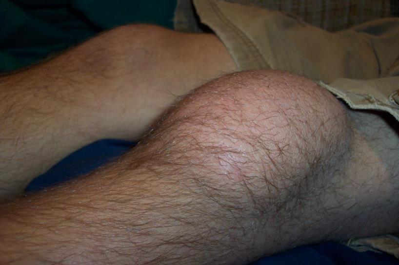Acute monoarthritis case 3 An 18 year old has been to Thailand on holiday and develops a painful swollen knee.
