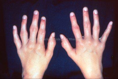 Polyarthritis Case 1 Emily, a 32 year old woman delivered her first child 6 months ago. She presents with a 3 month history of pain and swelling across her hands and wrists.