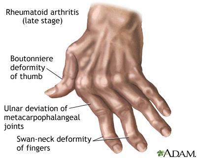 Deformities in RA Z thumb