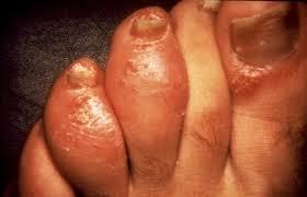 Polyarthritis case 2 A 45 year old gentleman presents with right knee and ankle pain. He also has noticed his left 3 rd and 4 th toes are swollen.