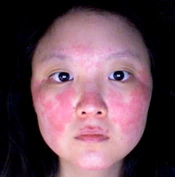 Classic skin rash Malar rash