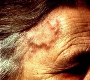Vasculitis case 1 Mrs F, 80 Attends the emergency department with visual loss and headache What else