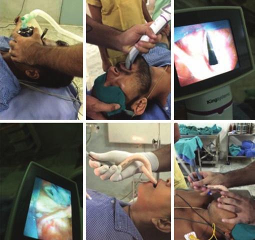 Siddhartha Hanjura et al the King Vision Video laryngoscope in aiding endotracheal intubation in Asian patients with normal airways.