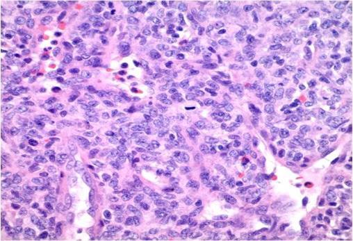 Hemangiopericytoma Facts Encapsulated hypercellular, hypervascular lesions derived from pericytes and