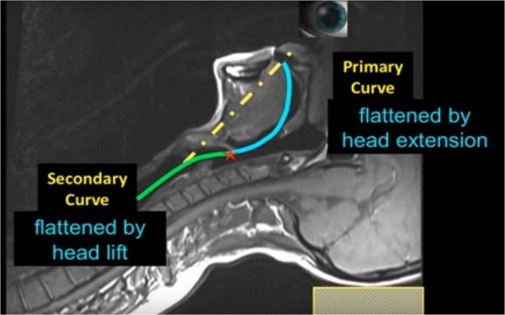 resonance imaging of normal airways: A new concept with