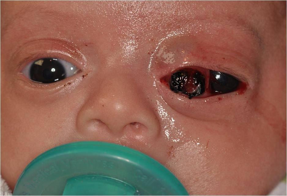 Case 8-week-old girl born at 36 weeks gestation with birth weight of 4 lbs and 3 oz,found at 4 weeks of age to have left eye discharge without other significant findings At 5 weeks mother noted
