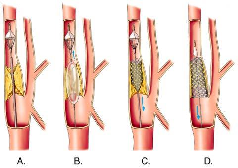 Trans-Femoral carotid stenting Lesion must be