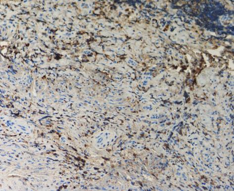 Case Reports in Otolaryngology 3 Figure 3: Immunohistochemical staining for total IgG in an area with inflammatory cells. The brown-coloured areas represent IgG. 200.