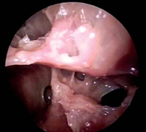 Towards the Understanding of Sinonasal Anatomical Variations A Cadaveric Study Figure 3: Endoscopic picture showing the natural and accessory maxillary ostia in cadaver the anterior ethmoid cells.