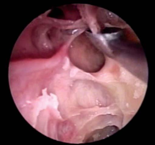 result in inadvertent frontal recess obstruction, lamina papyracea perforation, middle turbinate lateralization, or unnecessary posterior ethmoid dissection.