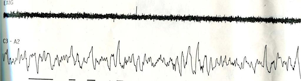 amplitude slow waves in EEG